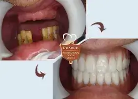 Aesthetic Denture