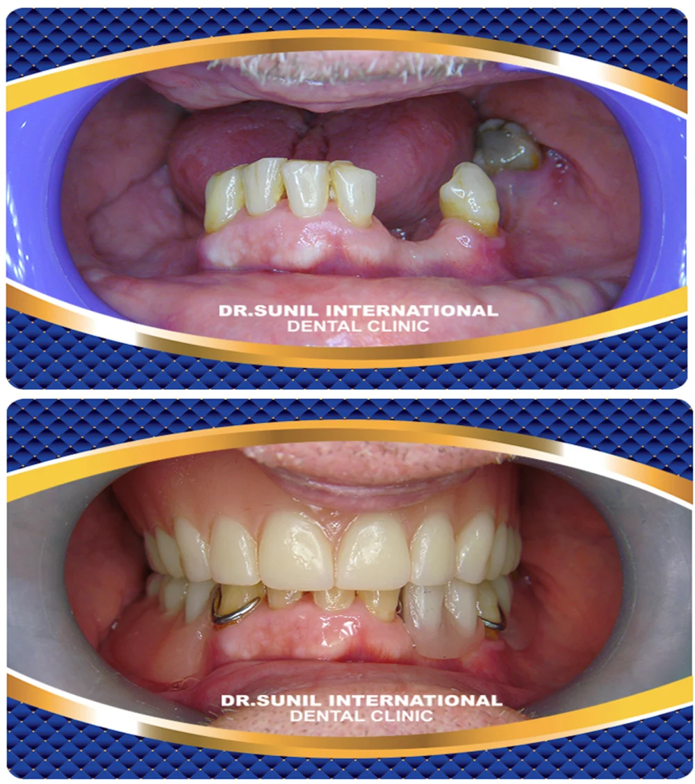 Dentures clinic in thailand